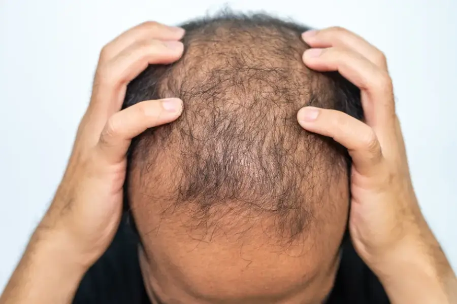 Maintenance Tips For Hair Systems From Hair Replacement Services in Des Plaines IL Maintenance Tips For Hair Systems From Hair Replacement Services in Des Plaines IL